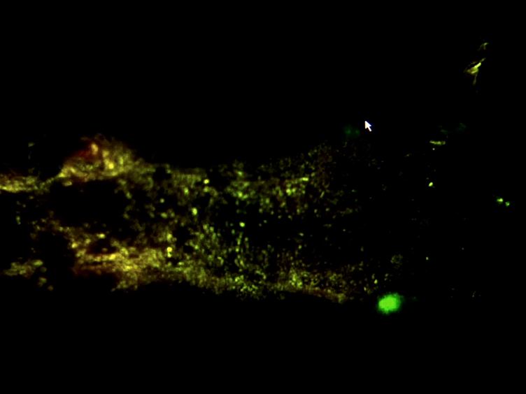 carcinoma prostata stadio ivoire