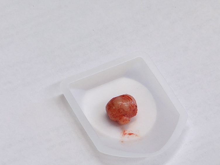 adenocarcinoma prostatico vie metastasi di china