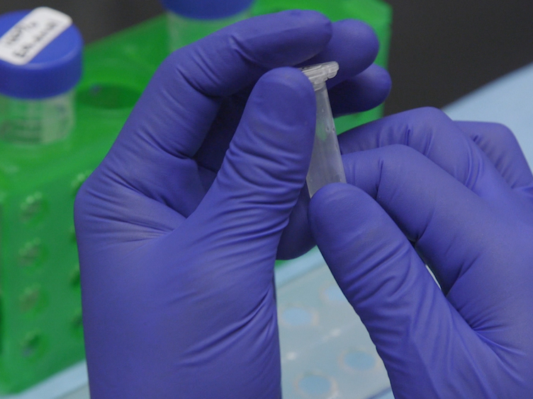 biopsia del punzone prostatico