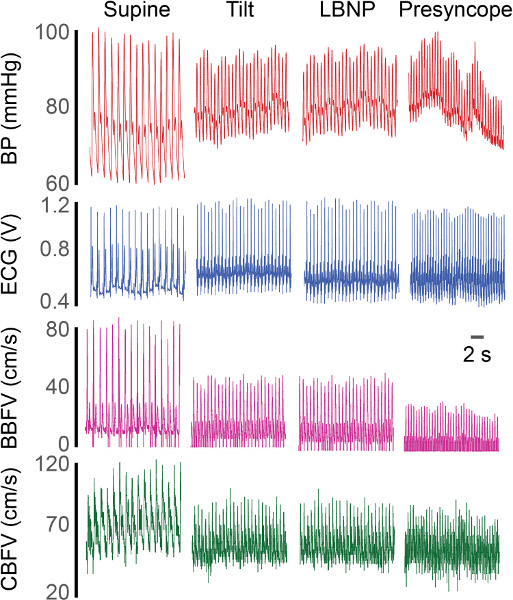 Tilt Table Test Positive Treatment Review Home Decor