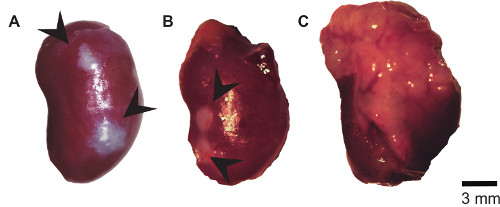 adenocarcinoma di tipo acinar della prostata adenocarcinoma di tipo acinar della prostata
