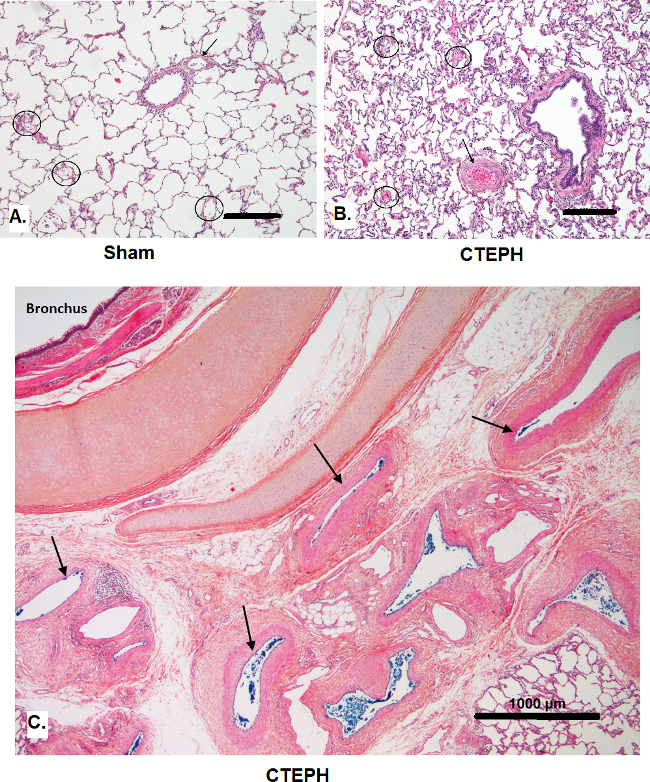 Pulmonar embolia 2018 para pdf diretrizes