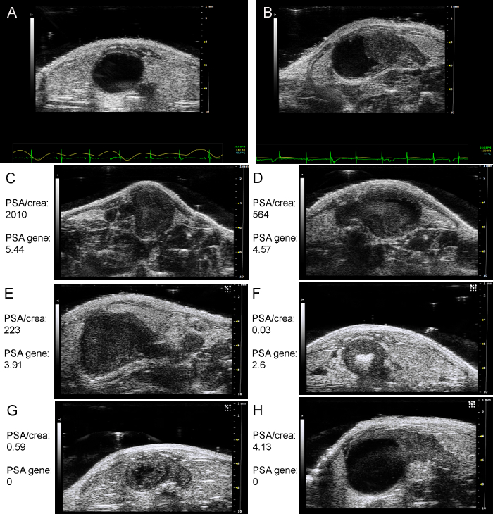 perché mri scan per il cancro alla prostata