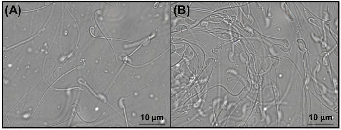 prostatite eiaculato acquoso