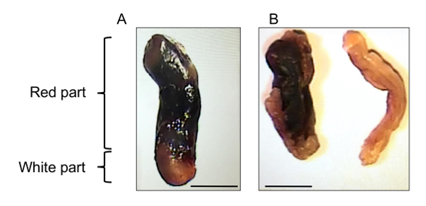 Tromboflebite nos sintomas mamários