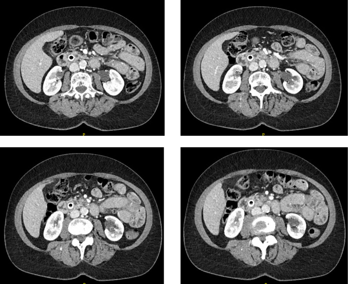 colangiografía intraoperatoria pancreatitis y diabetes