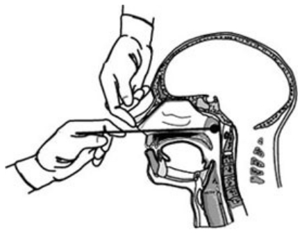 COVID-19 / Coronavirus Outbreak: Performing a Nasal Swab ...